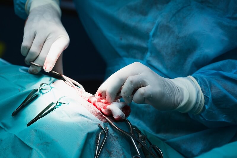 רשלנות רפואית בגין ניתוח איבר לא נכון